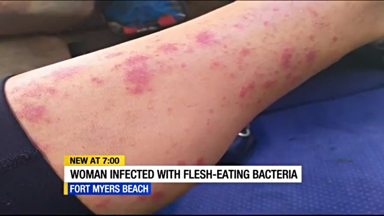 Five people have died so far this year from flesh-eating bacteria, according to data from the Florida Department of Health.
